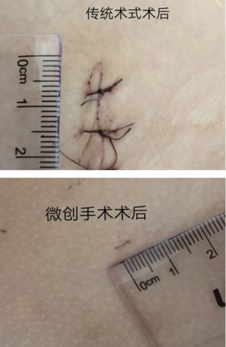 勐海县人民医院泌尿外科完成我县首例腹腔镜下鞘状突高位结扎术