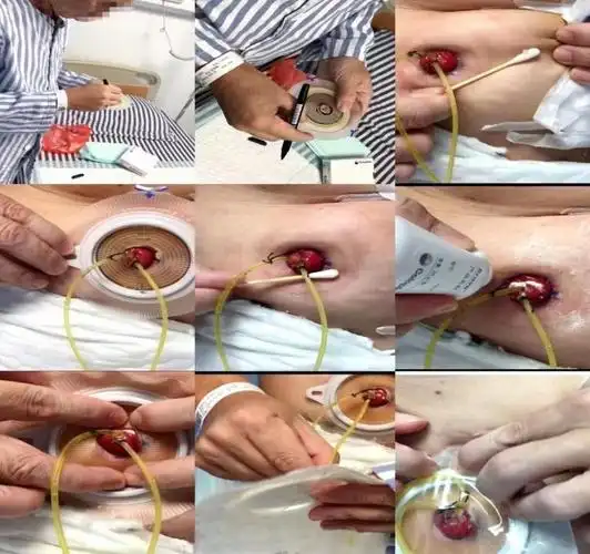 我院泌尿外二科团队创新护理模式助尿路造口患者顺利出院