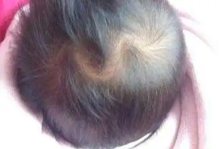 额头发际线上有牛头旋的女性也很固执.