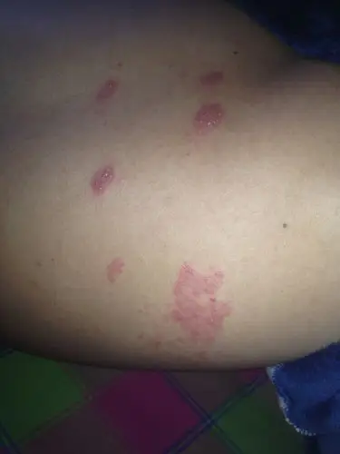 下面这两张图片是不是疱疹?该怎么治疗啊?