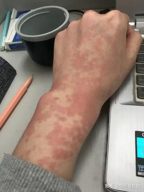 过敏性皮炎一周终于好了01