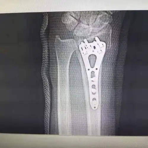 左桡骨远端粉碎性骨折切开复位钢板内固定术