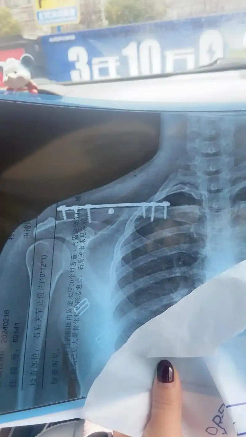 耗时二十一个月才长好,取了钢板.目前已经24个小时没吃没喝了 - 抖音