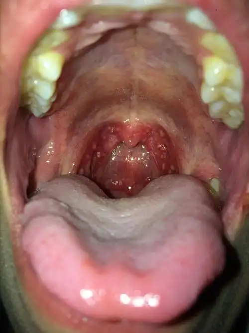 星期一喉咙痒,第二天我就去看医生了,是扁桃体化脓,体温37.