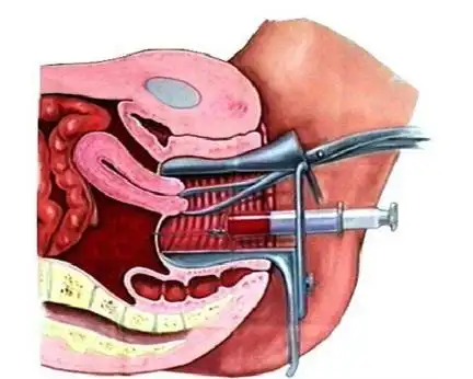 【图解疾病】宫外孕(异位妊娠)