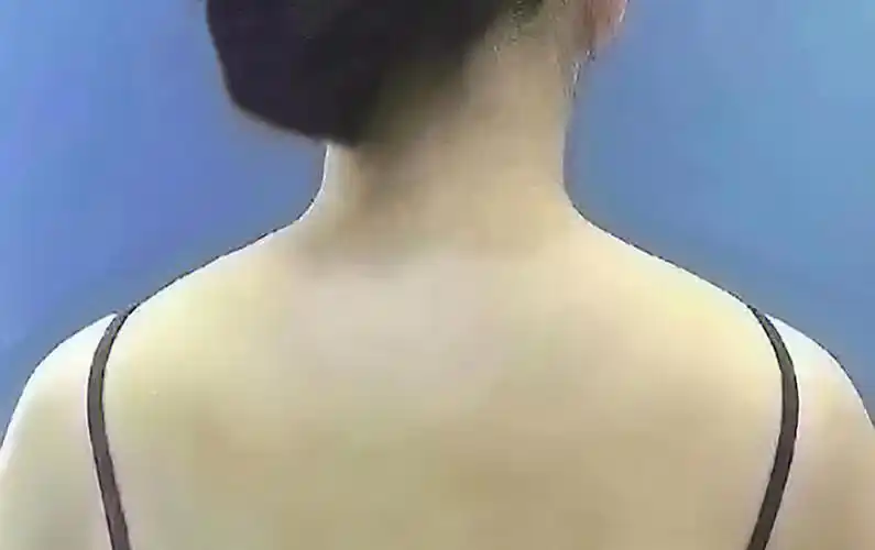 斜方肌肥大看过来教你轻松拥有天鹅颈