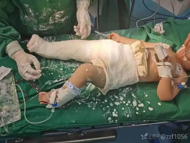 2岁女童拆石膏3天再骨折ddh先天性髋关节发育不良salter截骨术后六周