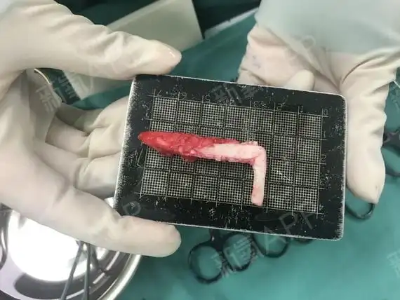 (取出的l型硅胶假体)