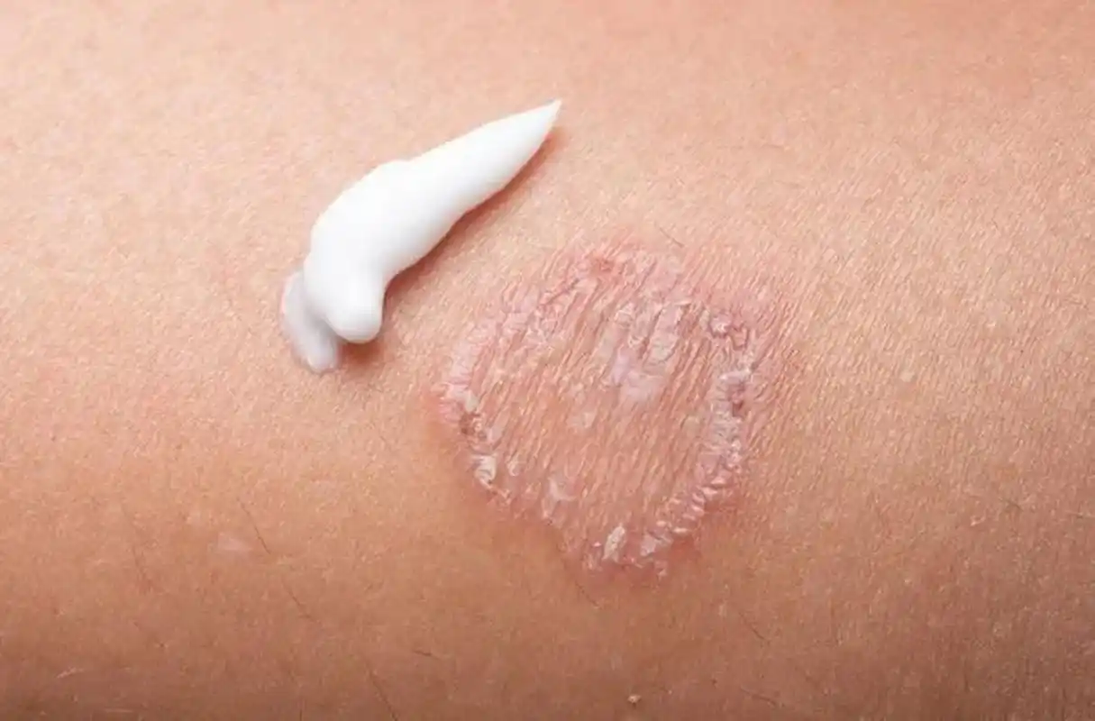 癣和皮炎湿疹经常容易搞混, 一个典型的症状有助于区分什么是癣.