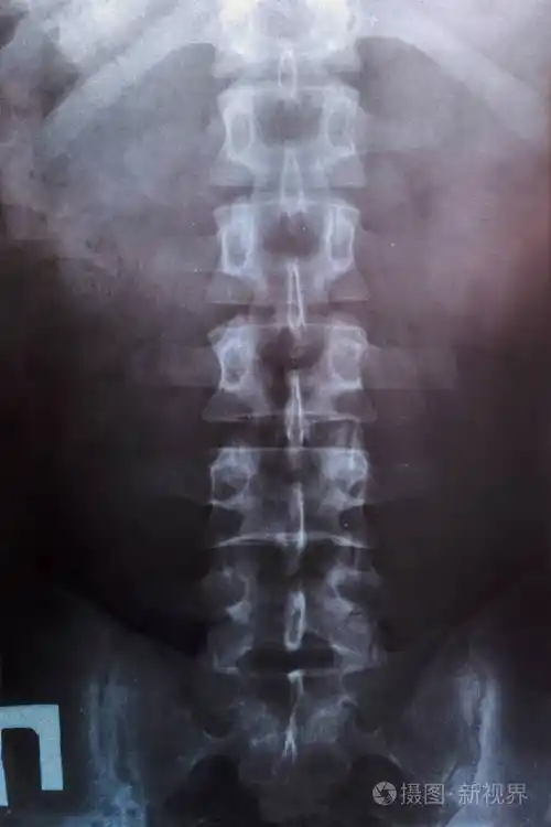 腰椎x光片