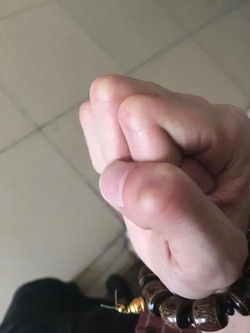 请医生看看我手指头是骨质增生还是骨刺?