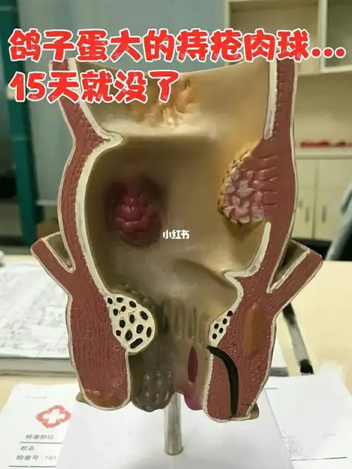 痔疮肉球从鸽子蛋到小米粒赞r15天就没了