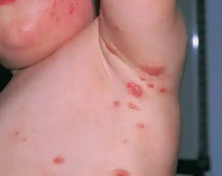 墨尔本蜱虫大量出没有人被咬后瘫痪预防措施都在这了