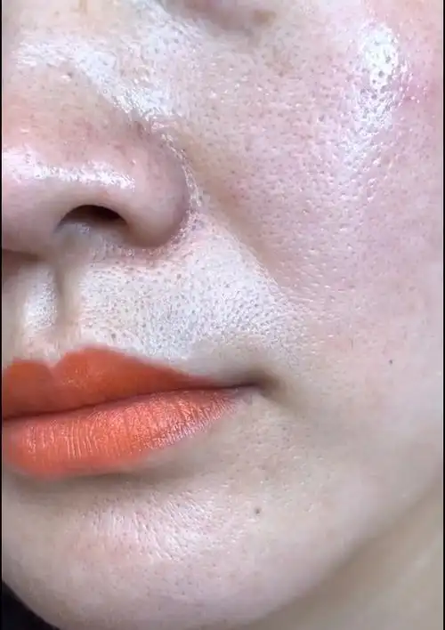 满脸油光 毛孔粗大