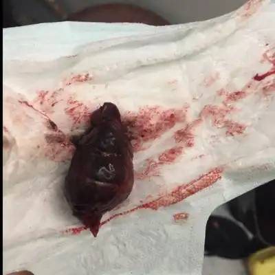 6月9号我流产了,当日排出来的,胚胎,但今日早上又排出来的不知道什麼