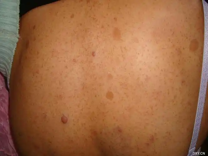 【求助】神经纤维瘤?