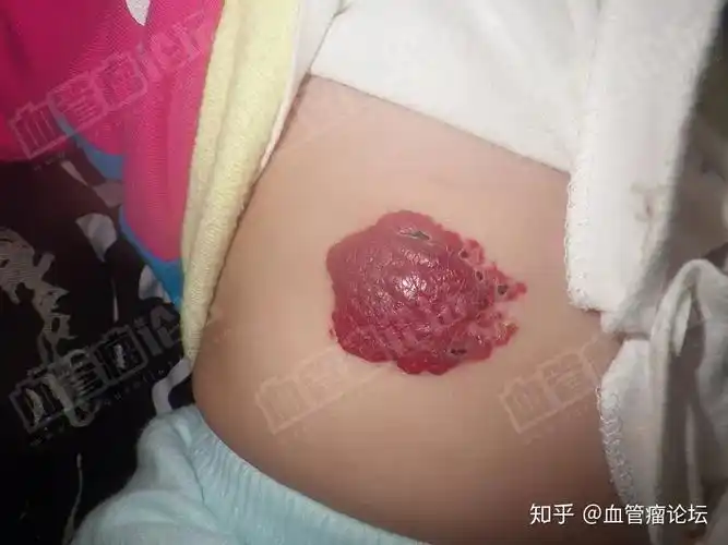 血管瘤论坛治疗2个月的宝宝腹部和耳部血管瘤治疗3个月效果家长满意