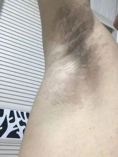 腋下长黑斑点是怎么回事?