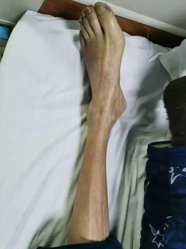 双下肢动脉硬化闭塞