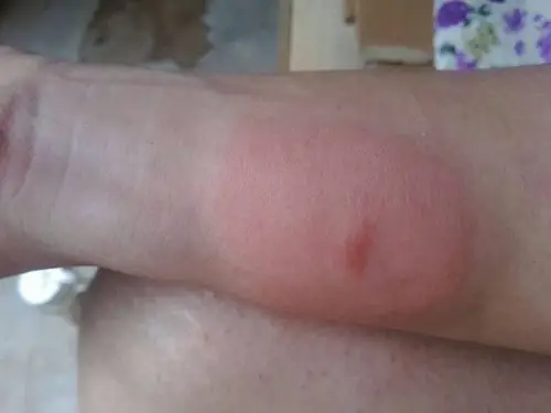 预防宝宝被虫咬皮炎图片