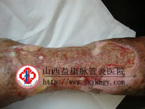 中西医结合治疗食管静脉曲张破裂出血32例