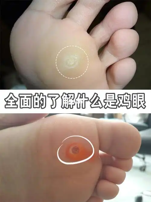 什么是鸡眼(形成的原因及治疗方法)_大全-幸福起航