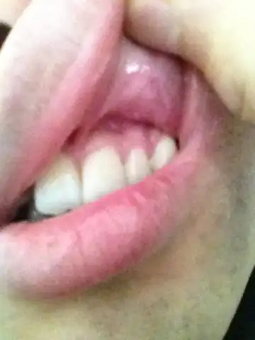 我看着我牙龈发白是怎么回事啊?