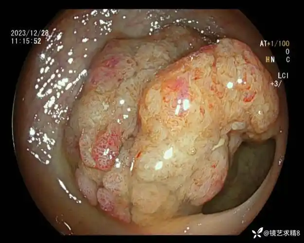 直肠巨大管状绒毛状腺瘤1例
