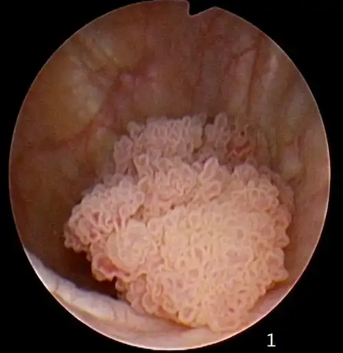 膀胱癌怎么切更彻底---等离子内镜微创手术 - 好大夫在线