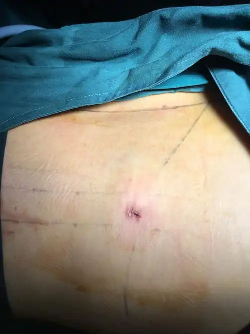 椎间孔镜下腰椎间盘突出症微创手术——安全,微创,恢复快_腰椎间盘