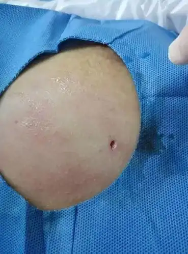 南阳医专一附院乳腺微创手术留你健康美胸