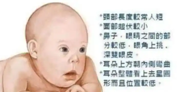 公开的资料显示:先天愚型是刚生下来的孩子中最常见的导致先天性痴呆