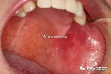 图片2,口腔黏膜红斑:是口腔黏膜上出现鲜红色,天鹅绒样斑块,好发于舌