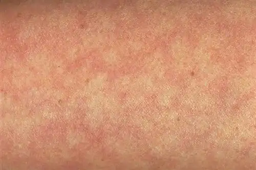 网状青斑和青斑性血管炎