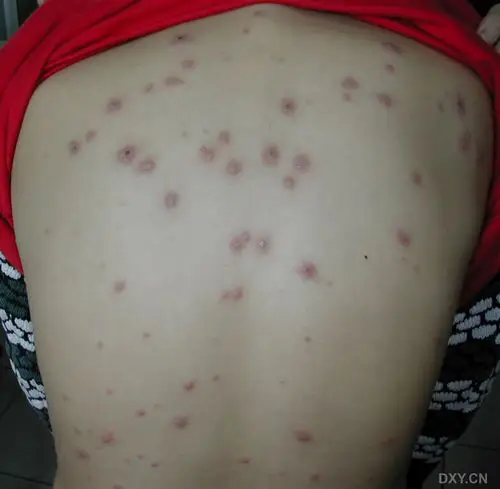 [原创 ]一例非常典型的 水痘 患儿病例照片! [病例帖]