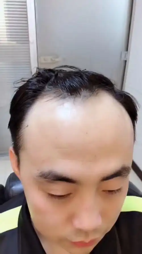 m型脱发  做完发际线,露出95意笑容