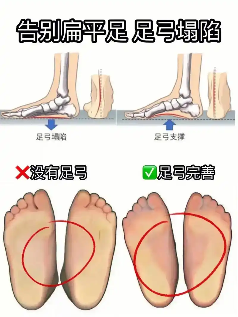 9615私我领取全套扁平足私教训练方案# - 抖音