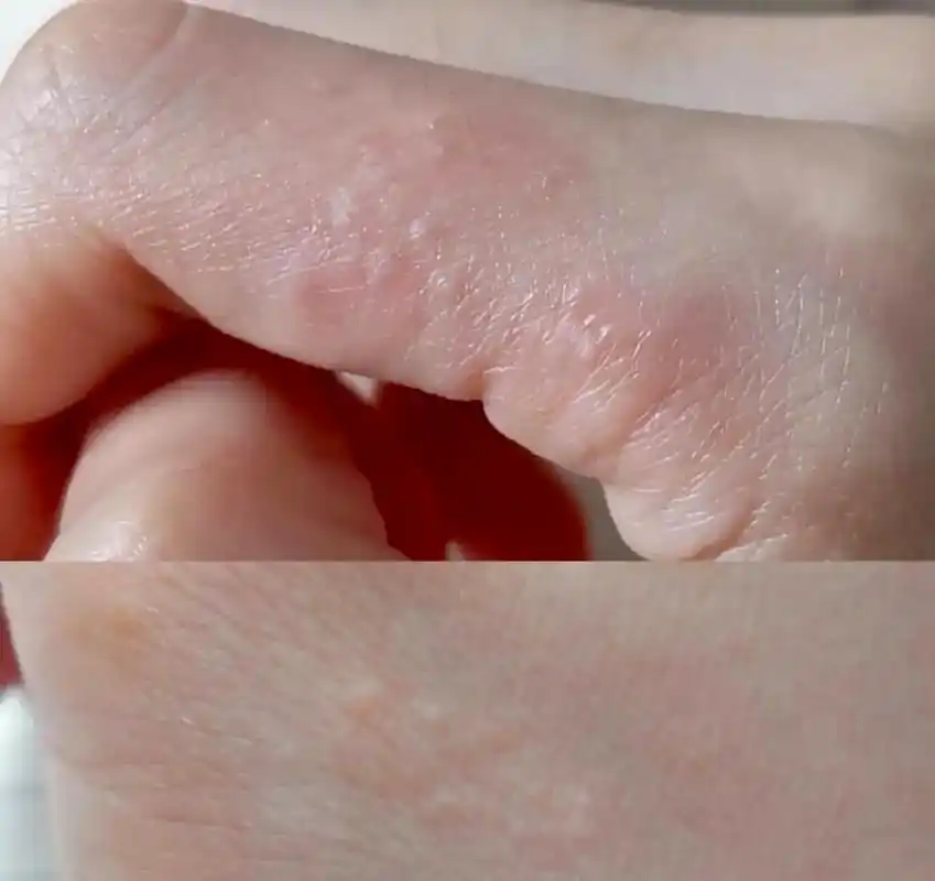 今天同事说他手上现在开始起小水泡了!  我一听,说"我手上也有!