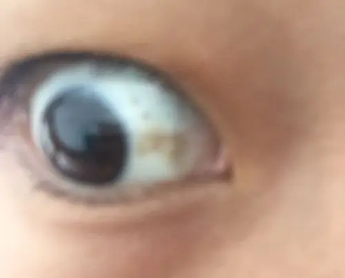 眼睛里面这个黄黄的一块是怎么了?