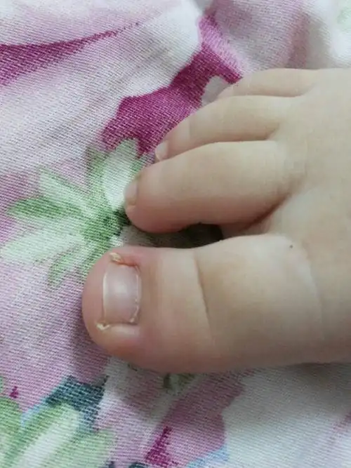 亲们看看我家宝宝的大脚趾头有问题吗?是医生的最好,谢谢了