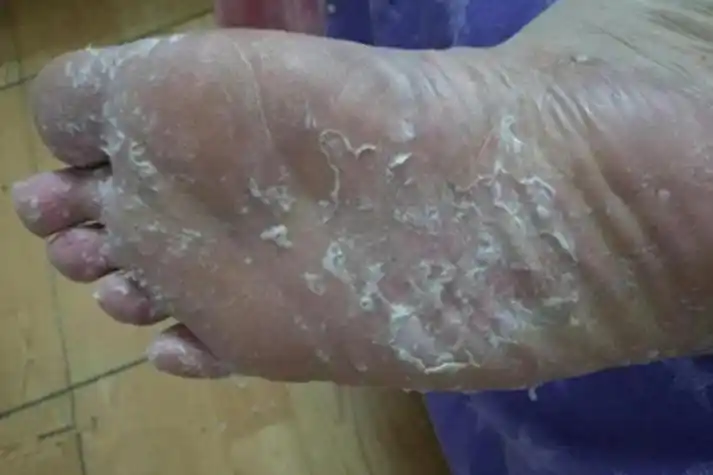 浸渍擦烂性皮炎脚底肿图片