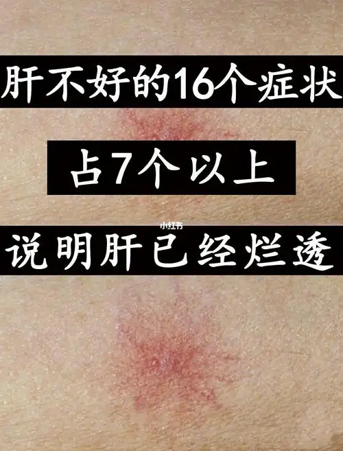 肝不好的16个症状占7个说明肝已烂透