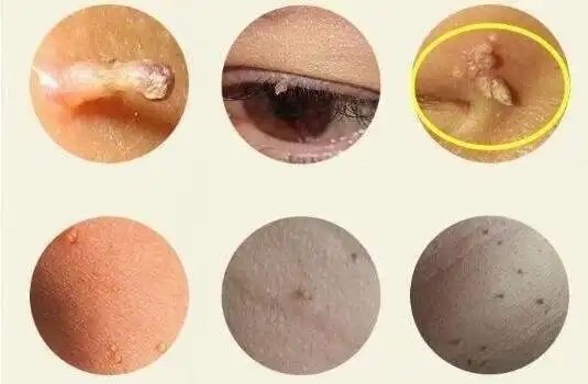 女性hpv病毒女性症状图片 各类型初期小疣体图片