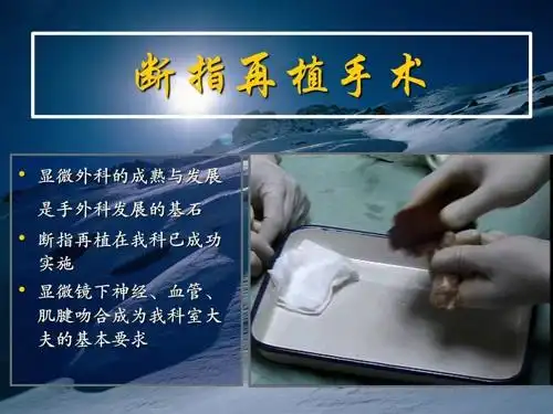 手外科是骨科最为成熟的技术