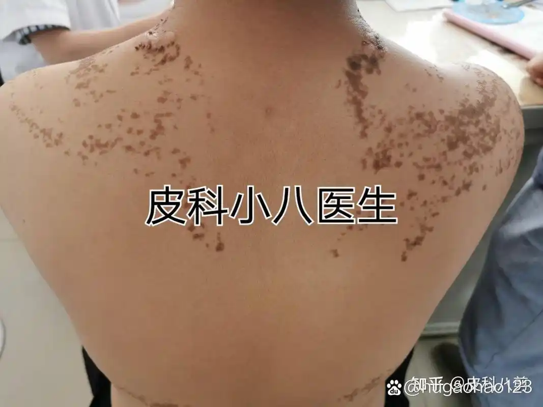 皮科小八医生线状表皮痣