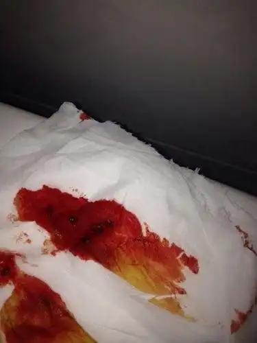 便这是大便带血这种颜色需谨慎当心是癌请问这个是大便带血吗大便带血