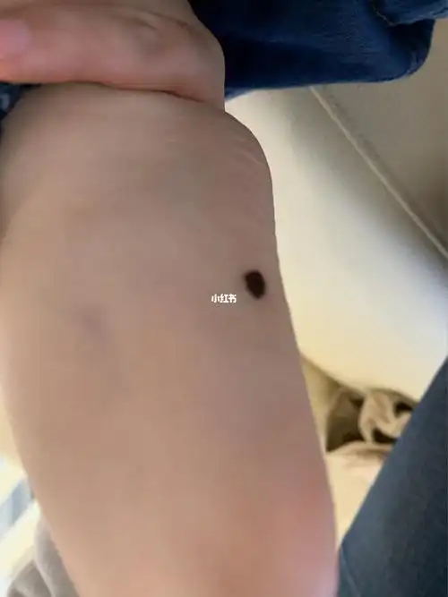 3岁宝宝切脚上的黑痣邓丹医生_小朋友_万豪酒店怎么样_儿科_动画片