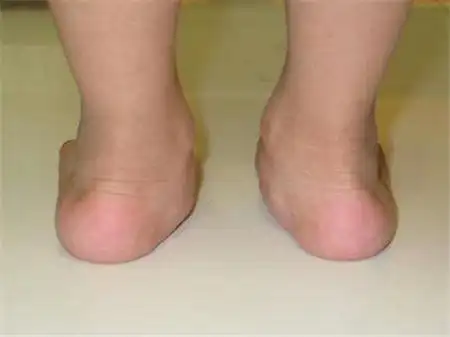 新生儿脚外翻什么原因2