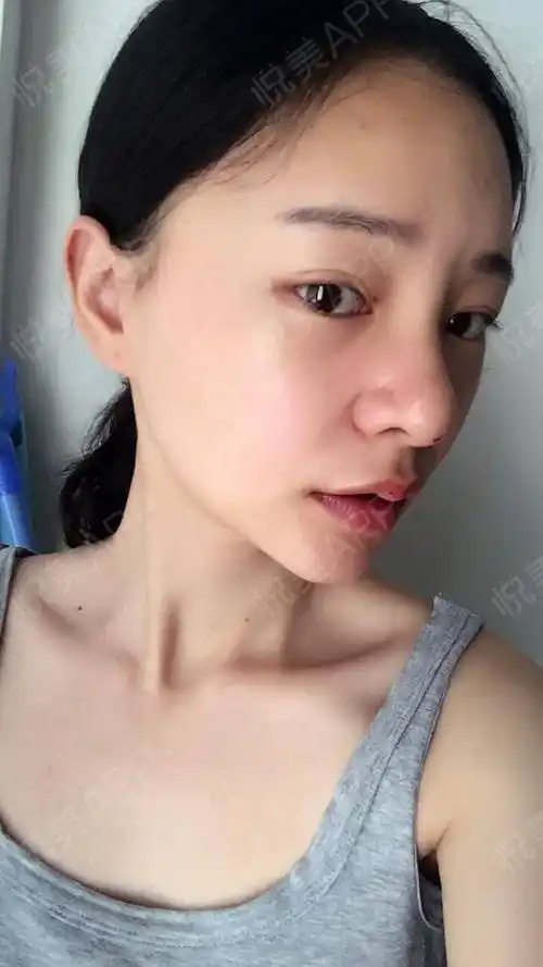 线雕隆鼻术后3天_隆鼻术后3天_鼻部整形术后3天_徒留,孤单分享图片7