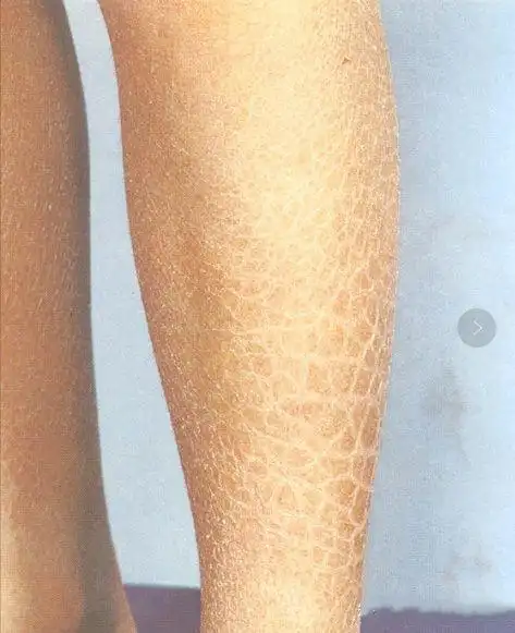 之后几个月开始出现并逐渐加重,有褐色皮屑,像鱼鳞一样贴在皮肤上